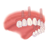 Vollprothese auf Implantaten